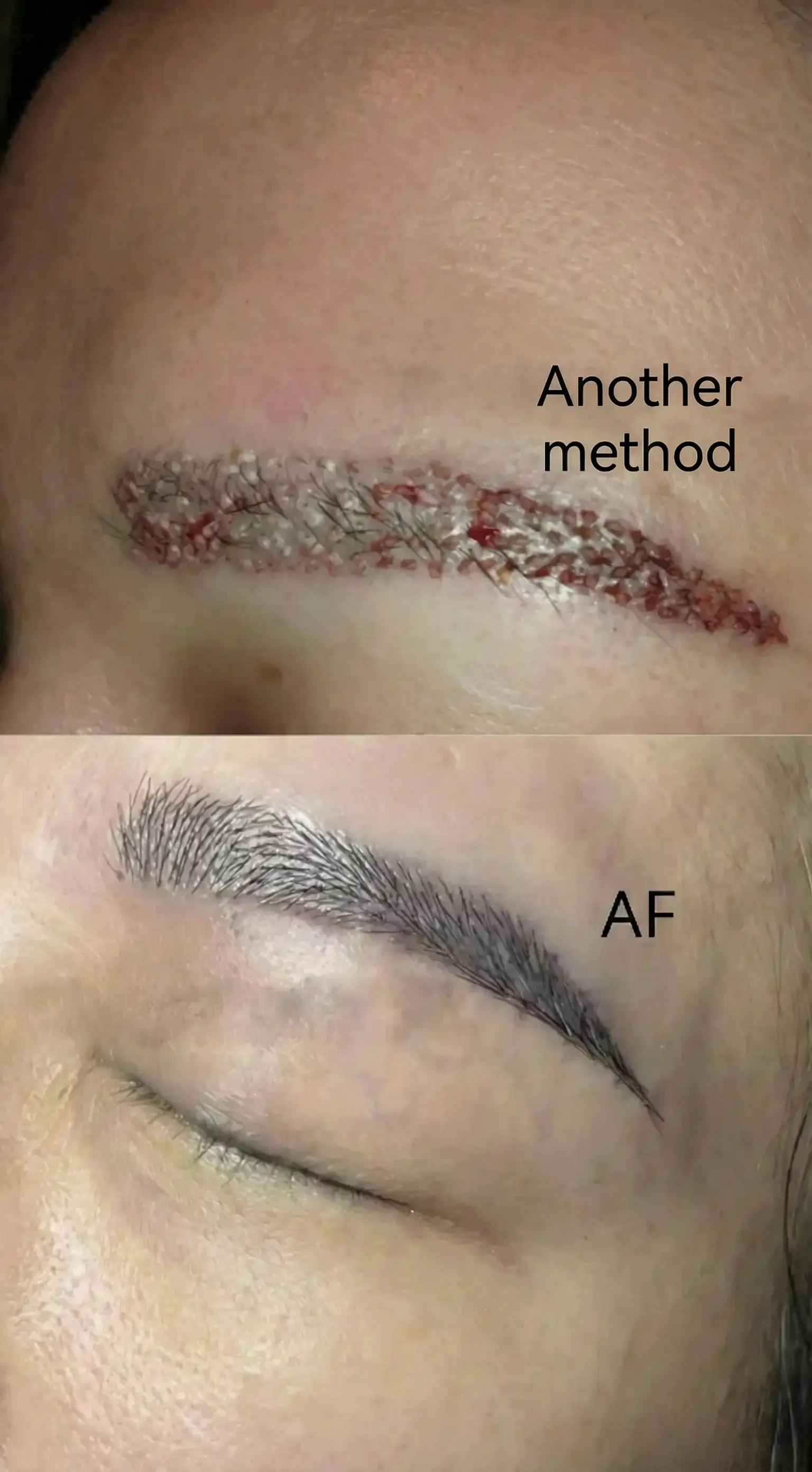 AF vs FUE hair transplant comparison - Follicle survival and healing time comparison